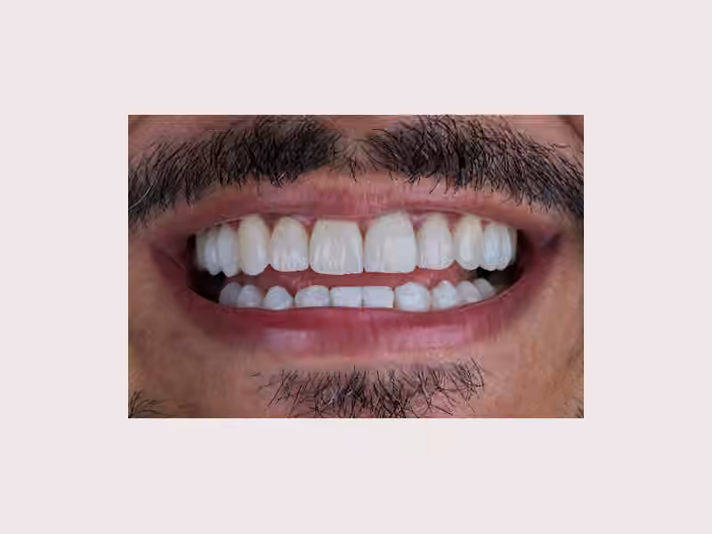 Diseño de sonrisa Manizales Luz Adriana Medina Alta Estética Dental