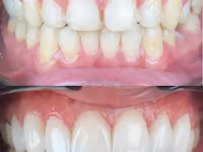 Elite Smile | Diseño de Sonrisa | Porcelain Veneers Barranquilla