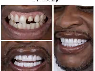 Diseño de Sonrisa | Blanqueamiento Dental | Veneers | Dental Implants