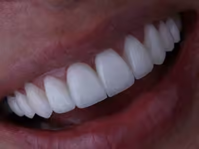 Diseño de Sonrisa Manizales - Carolina Gómez Odontología