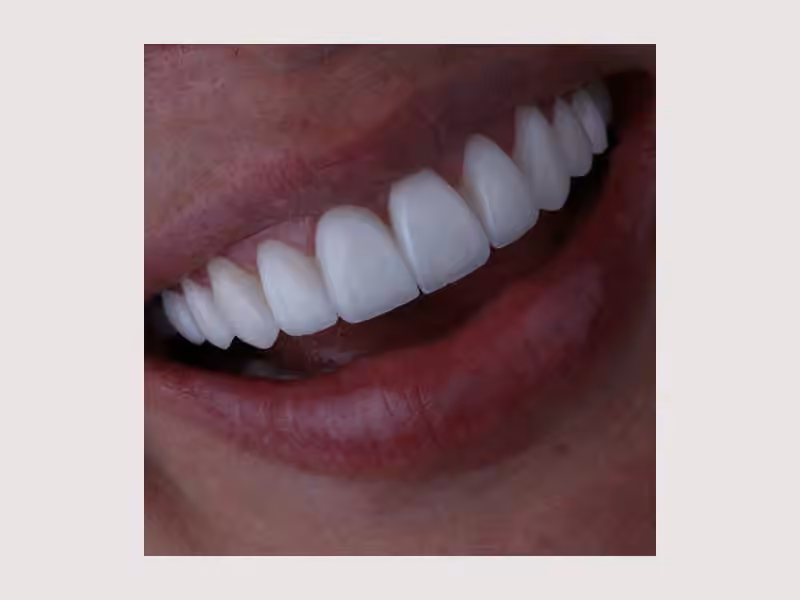 Diseño de Sonrisa Manizales - Carolina Gómez Odontología