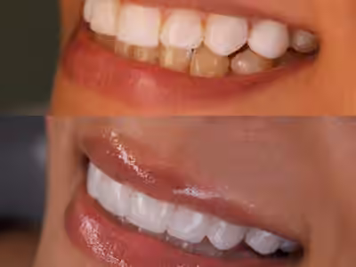 Macrodent sede Altico / Diseño de sonrisa en Neiva
