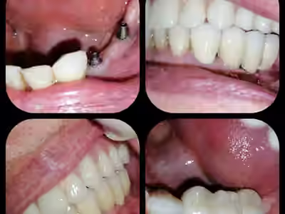 Urgencias odontologicas/Dra. Carolina Moreno Esp. Rehabilitación Oral-Dra. Manuela Buitrago Esp Cirugía oral
